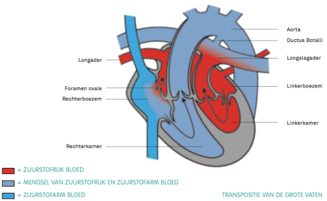 Transpositie van de grote vaten Transpositie van de grote vaten